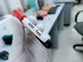 Rękawiczka trzyma probówkę z krwią do testu ASO. Podwyższone ASO może wskazywać na bóle stawów.