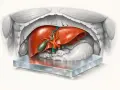 Anatomical illustration of a healthy liver, gallbladder, pancreas, and diaphragm. This ast norma shows the organs in their typical position.