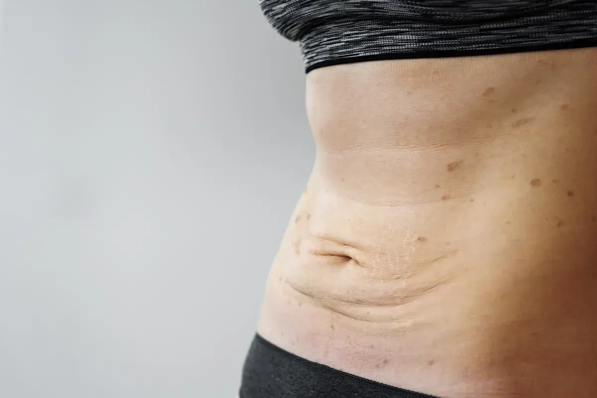 Skóra po schudnięciu 20 kg. Widoczne luźne fałdy na brzuchu, rozstępy i przebarwienia.