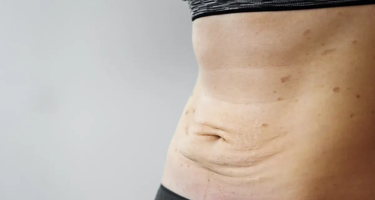 Skóra po schudnięciu 20 kg. Widoczne luźne fałdy na brzuchu, rozstępy i przebarwienia.