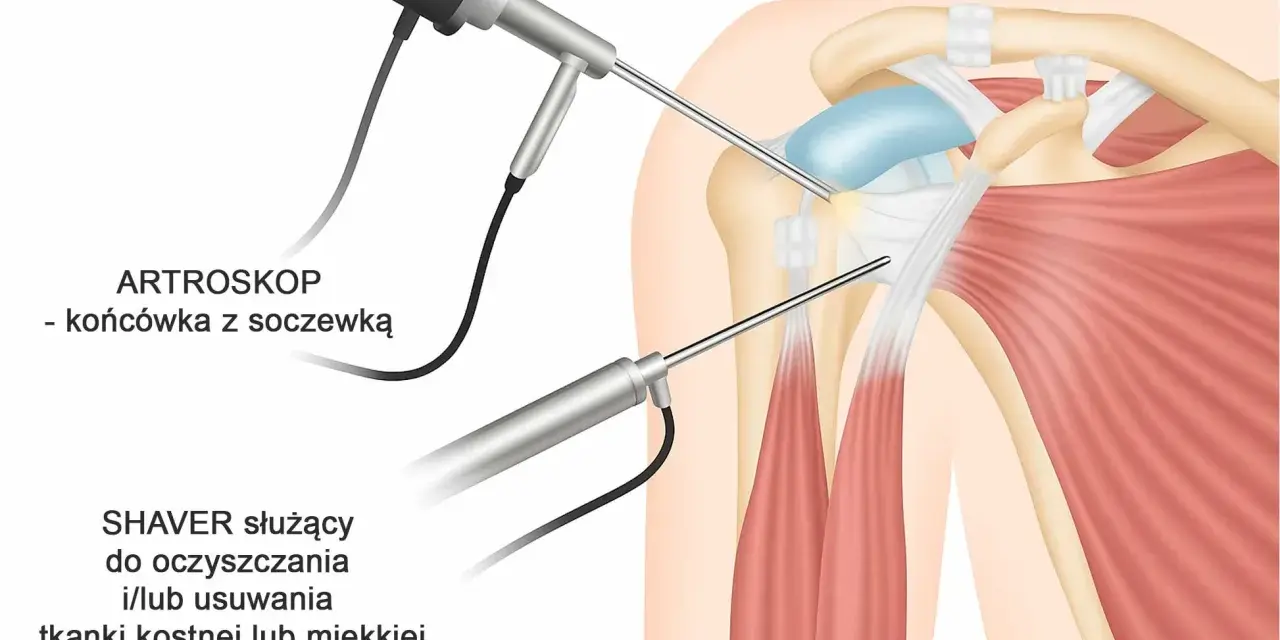 Artroskopia stawu barkowego: artroskop i shaver pracują w okolicy obojczyków, oczyszczając tkanki.