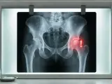 RTG miednicy z zaznaczonym bólem biodra. Czy rwa kulszowa wyjdzie na RTG? Zwykle nie, ale zmiany zwyrodnieniowe mogą ją powodować.