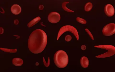 Czerwone krwinki w kształcie dysków i sierpowate, jak przy niedokrwistości sierpowatej. Pytanie "pdw co to" może dotyczyć tej choroby.