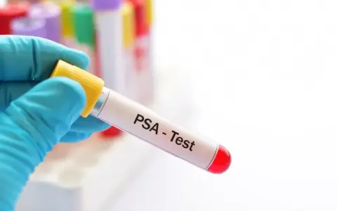 Rękawiczka trzyma probówkę z napisem "PSA - Test". To badanie psa, które pozwala ocenić jego stan zdrowia.