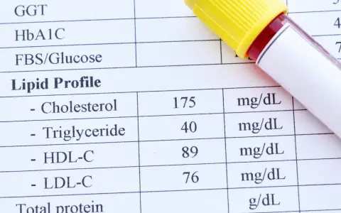 Wynik lipidogramu: cholesterol HDL w surowicy wynosi 89 mg/dL. Obok leży probówka z krwią.