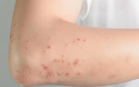 Skóra na łokciu z zaczerwienionymi, swędzącymi zmianami, które mogą być objawem reakcji na histaminę.