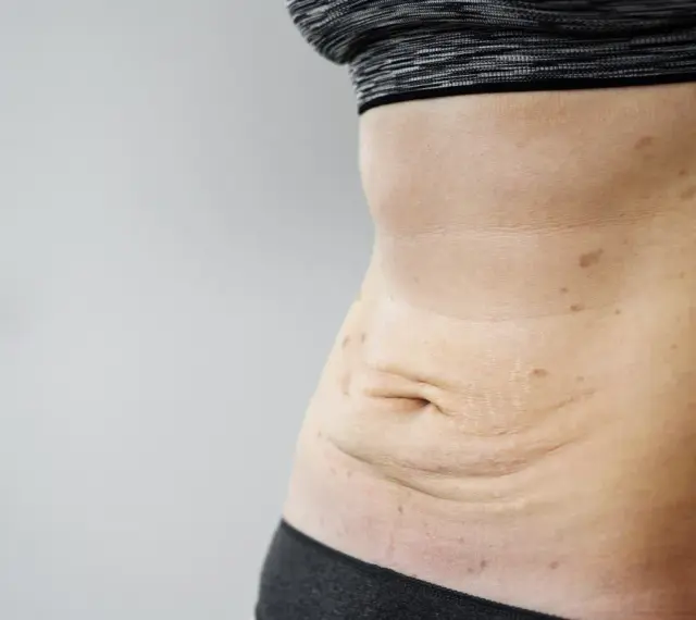 Skóra po schudnięciu 20 kg. Widoczne luźne fałdy na brzuchu, rozstępy i przebarwienia.