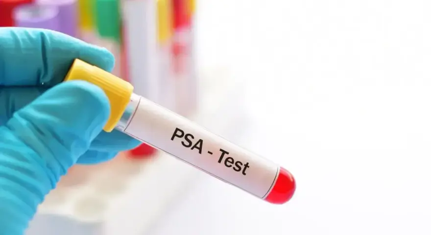 Rękawiczka trzyma probówkę z napisem "PSA - Test". To badanie psa, które pozwala ocenić jego stan zdrowia.