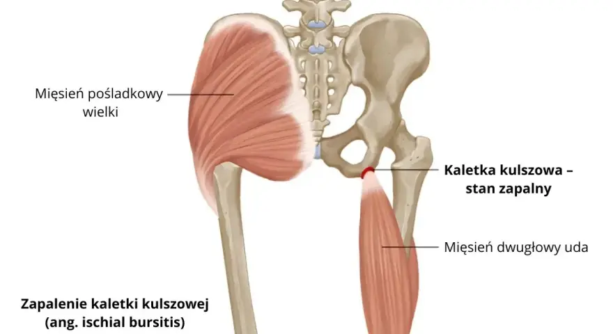 Zapalenie kaletki kulszowej, czyli stan zapalny w okolicy guza kulszowego, widoczny na tle miednicy i mięśni.