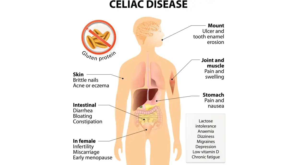 Objawy celiakii: problemy skórne, jelitowe, bóle stawów, żołądka, a nawet problemy z płodnością. Alergia na gluten może objawiać się na wiele sposobów.
